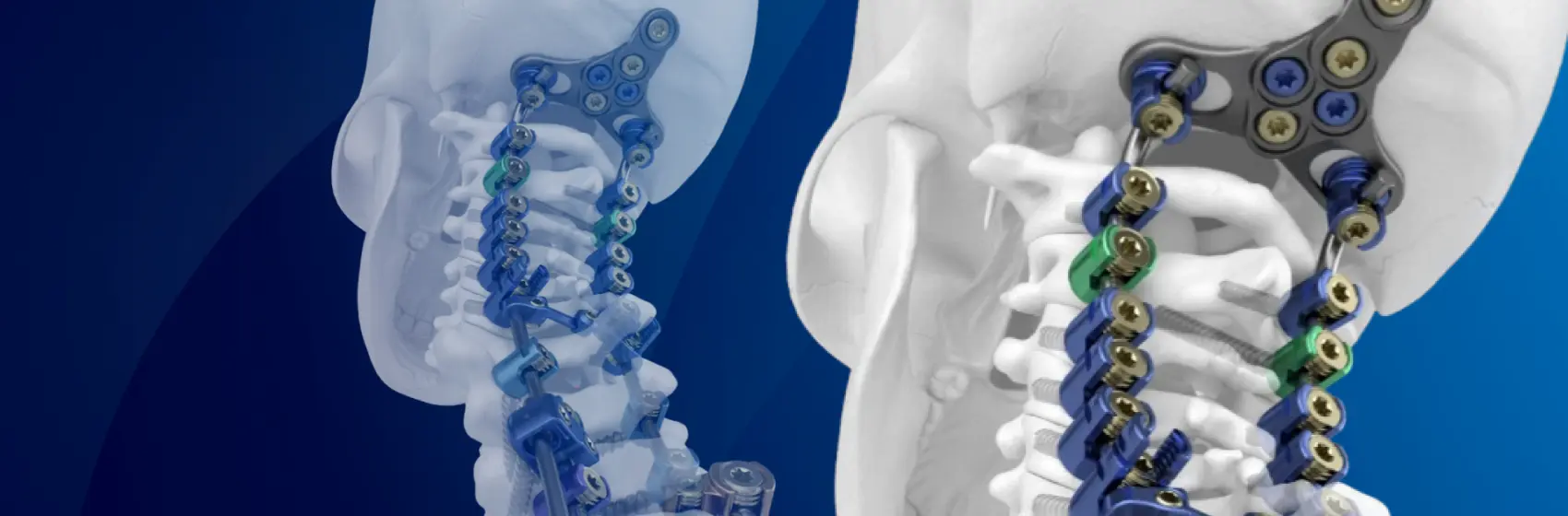 Implantes quirúrgicos